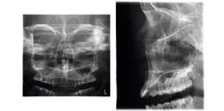 Planmeca ProOne Programmi di imaging ottimali Panoramica standard Segmentazione