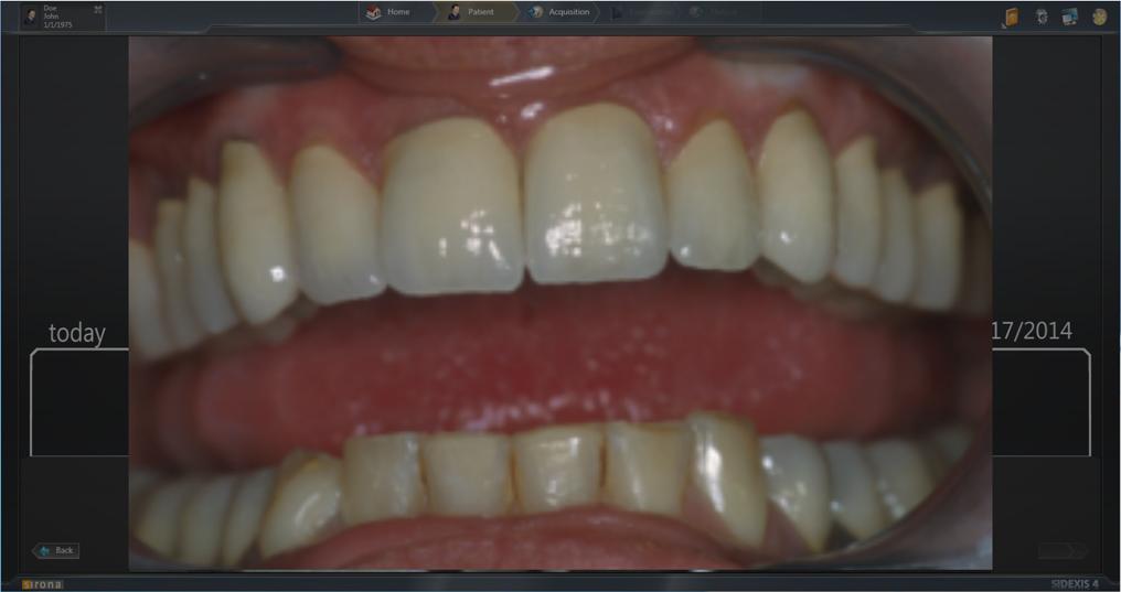3 Uso Sirona Dental Systems GmbH 3.3 Commutazione tra immagine live e immagine fissa Plugin video per SIDEXIS 4 TENEO / SINIUS / INTEGO 3.