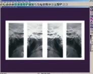** Nel Planmeca Proline XC, il programma seni ha uno strato di immagine specifico che permette di ottenere una radiografia con una visione chiara dei seni mascellari.