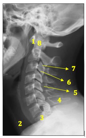 Cervicale 1- Arco anteriore dell atlante 2- Trachea 3- Corpo vertebrale D1 4- Processo spinoso C7 5-