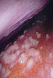 Sintomi Dispnea (per versamento o masse pleuriche) Dolore toracico Ascite (per interessamento peritoneale) Diagnosi