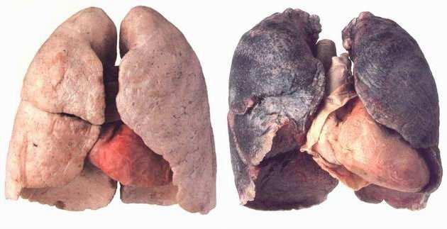 Fattori di rischio Fumo di sigaretta (85% dei casi) Rischio relativo fumatori vs non fumatori: da 14 a 20 volte più alto, sembra ridursi progressivamente nell