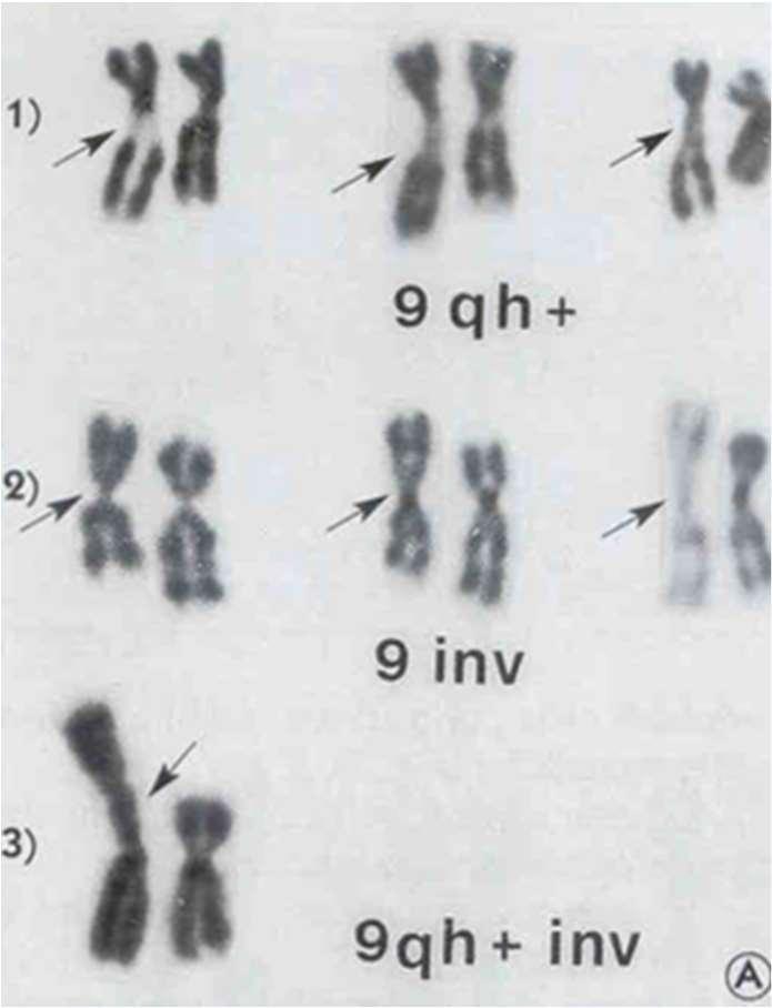 Variazioni dell eterocromatina pericentromerica Sono in genere espansioni, ma anche