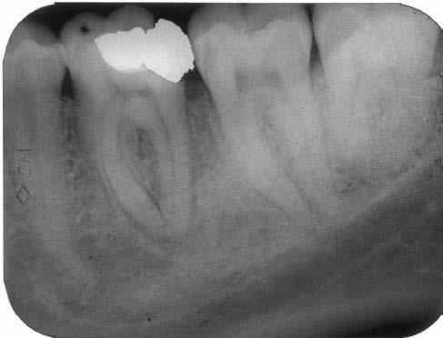 Caso clinico 6 Paziente: C.C. - anni 35 Sesso: M Elementi dentari interessati 36 Necrosi gangrenosa pulpare e osteite apicale - chirurgica ed estrattiva Prodotto utilizzato Endocalex Plus + Endocalex