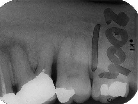 46; carie sottocoronale con necrosi gangrenosa pulpare; A.c.p. + alesatura n. 3 canali radicolari; drenaggio + Amoxicillina. 29/11/96 Endocalex 6-9 + otturazione provvisoria.