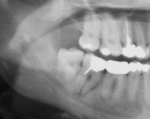 emiarcata inferiore dx; richiesta xgrafia. 3/1/01 Pulpite acuta di 47; sensibilità pulpare ridotta; A.c.p.: n. 3 canali; alesatura canali radicolari; drenaggio; Amoxicillina.