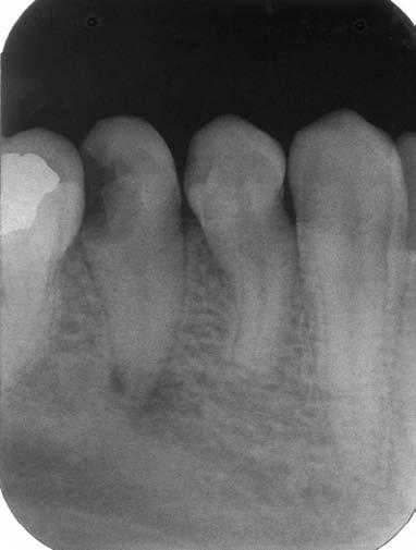 18/3/98 Otturazione definitiva in amalgama dʼargento in assenza di qualsiasi sintomatologia.