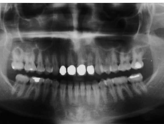 Caso clinico 45 Paziente: P.C. - anni 52 Sesso: M Elementi dentari interessati 22 (ed occasionalmente 21) Ascesso odontogeno e necrosi