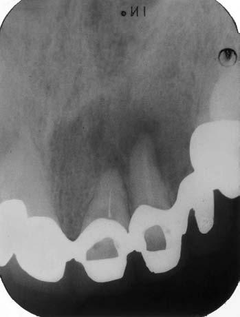 1 - Lesione osteolitica periapicale di 22 e di minor estensione ed intensità anche di 21. (13/11/03) Fig.