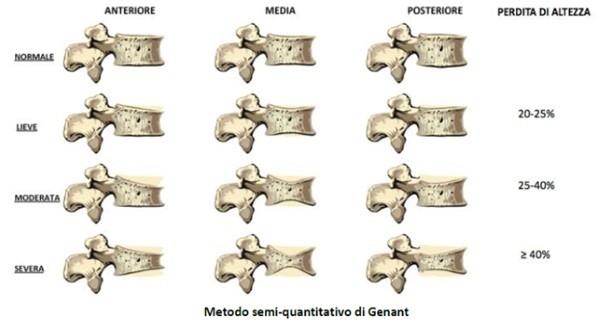 Fig. 3: classificazione di Genant per le fratture vertebrali In base alla gravità della frattura, quindi, distinguiamo 3 gradi: frattura lieve: riduzione di una delle altezze del 20-25%; frattura