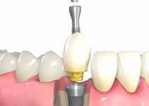 Tissue Level Corona Singola Avvitata Usando RN come esempio Presa d impronta 2 Realizzazione del