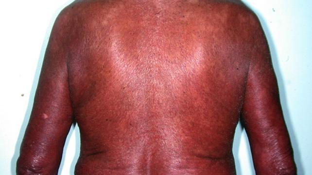 glicopeptidi Reazioni immuno-mediate immediate e nonimmediate sono infrequenti Sindrome dell uomo rosso da stimolazione