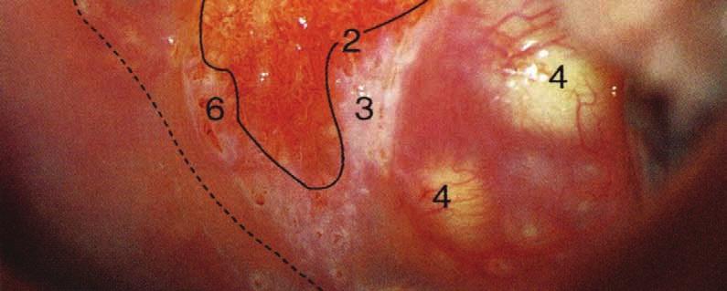 Epitelio squamoso metaplasico Cisti di Naboth A.