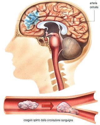 Accidenti cerebro-vascolari acuti Il sangue non arriva a una porzione del cervello Sintomi cefalea improvvisa intensa alterazioni dello stato di coscienza