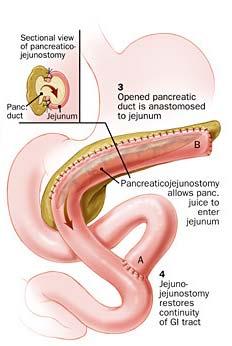 resection Puestow