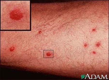 Patologia-sintomi della bilharziosi Dermatiti causate dalla penetrazione delle cercarie Sintomi