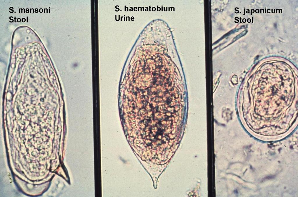 Schistosomiasis Diagnosi di laboratorio - Può essere presente eosinofilia. - Ricerca delle uova nelle urine (S. haematobium).