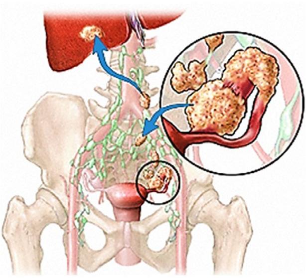 Diffusione locoregionale e sistemica del carcinoma