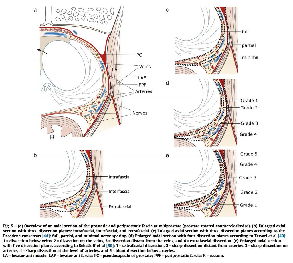 Fisiopatologia della DE post RP Approccio Nerve Sparing Incrementale Tewari: 4 gradi di Nerve Sparing usando come limite il plesso venoso laterale alle prostata.