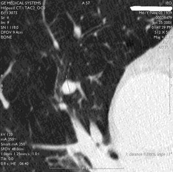 screening-detected lung nodules