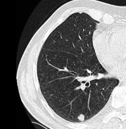 standard: 14%) Cosa sappiamo dello screening: 1) I tumori vengono diagnosticati in stadio pre-clinico, ma nella