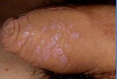 Patologie non infettive Psoriasi Dermatite