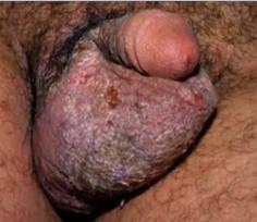 Patologie non infettive Psoriasi Dermatite seborroica Dematite atopica