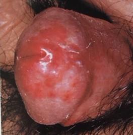 (lesioni Ulcera molle eritematoerosive, Uretriti
