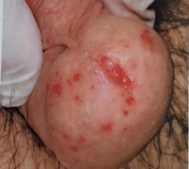 acuminati o Verruche genitali Herpes genitale