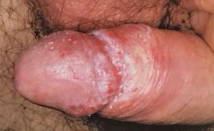 Herpes Zoster eritematoso e Mollusco contagioso