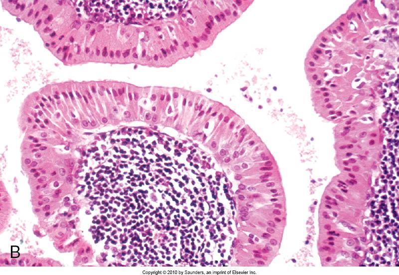 palpabile Colore grigiastro Presenza di spazi cistici