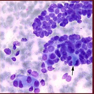 crescita lenta Dolore Ulcerazione cute/mucosa Metastasi a