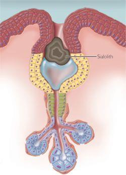 Eziopatogenesi Alterazione della secrezione salivare Iniziale nucleo organico (mucine, cell. desquam., microorgan.