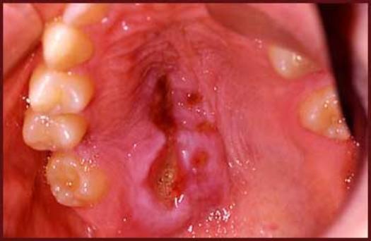 sialometaplasia necrotizzante Eziopatogenesi Non chiara