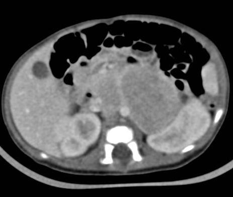 superiore. Anse intestinali dislocate anteriormente Pancreas spinto superiormente.