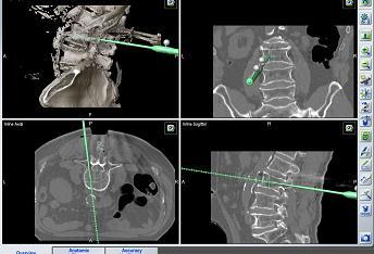 Indicazioni neurochirurgiche per la Tac intraoperatoria Interventi di stabilizzazione della colonna vertebrale (cervicale-dorsalelombosacrale) Consente di posizionare i