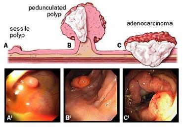POLIPI Polipo sessile: neoformazione