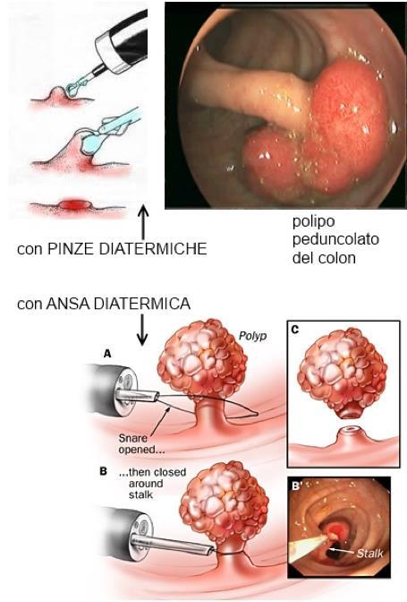 Identificazione e classificazione endoscopica Il primo passo, durante lo studio della mucosa del colon, è rappresentato dal riconoscimento, all endoscopia con luce bianca, di tutte quelle aree