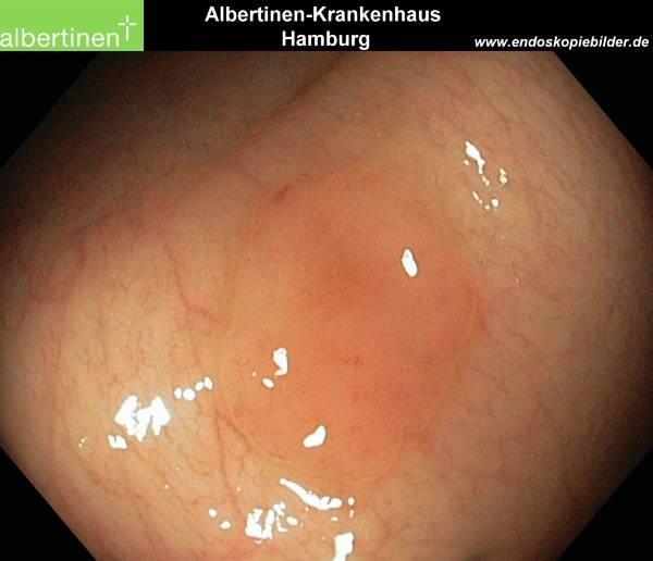 POLIPI IPERPLASTICI Sebbene nel passato siano state ampiamente considerate lesioni non neoplastiche e non evolutive, recentemente è stato riconosciuto un potenziale neoplastico di queste lesioni noto