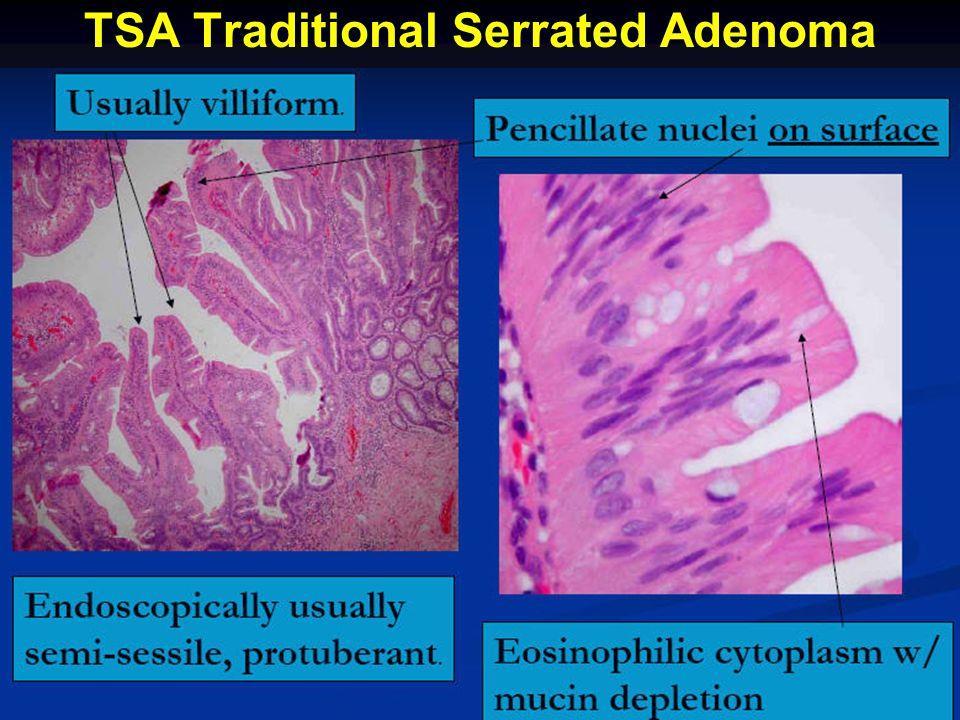 Adenomi serrati tradizionali Gli adenomi serrati tradizionali (adenoma serrato polipoide, adenoma serrato di tipo 1) presentano due caratteristiche istologiche: una componente ghiandolare serrata e