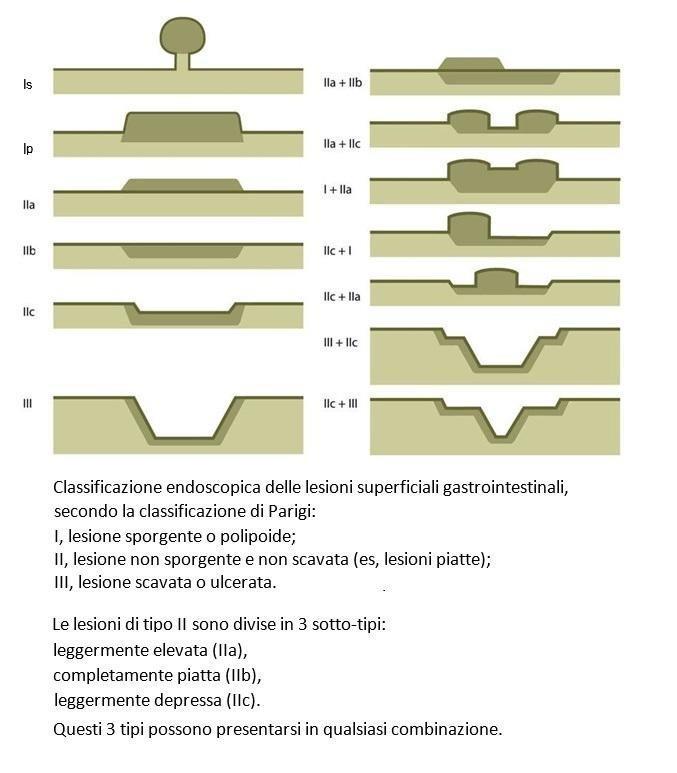 Classificazione di Parigi Le lesioni protrudenti lievemente rilevate (0-IIa) che presentano un prevalente sviluppo laterale con un diametro maggiore di 10