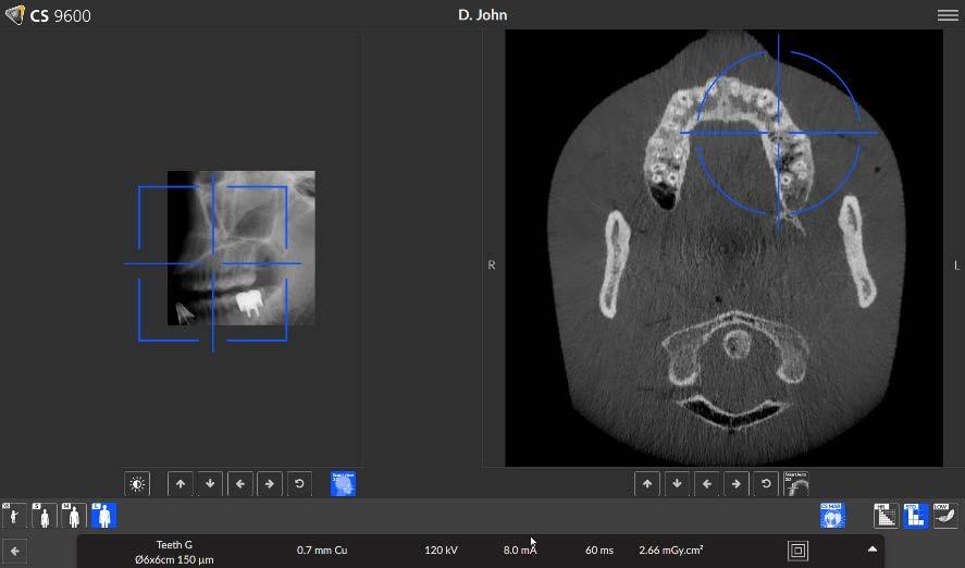 Tecnologia SmartAuto ESAME PANORAMICO Una vista scout a bassa dose acquisisce la forma della mascella / mandibola del paziente e la posizione in tre dimensioni