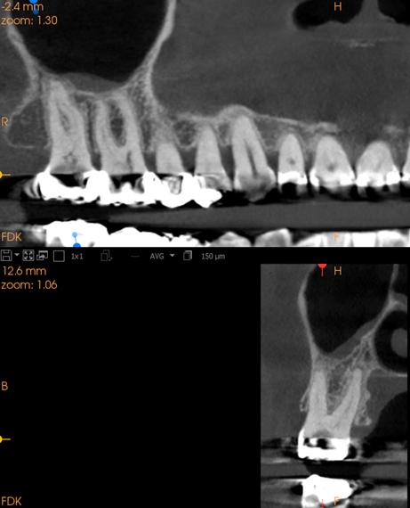 CS MAR Permette il confronto dal vivo di immagini con e senza filtro MAR Aiuta a