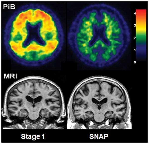 Suspected non-alzheimer disease pathophysiology (SNAP) Individui con marker di neurodegenerazione anomali (MRI, FDG-PET, CSF t-tau) ma senza evidenza di