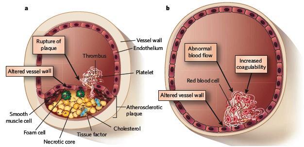 Trombosi arteriosa e venosa