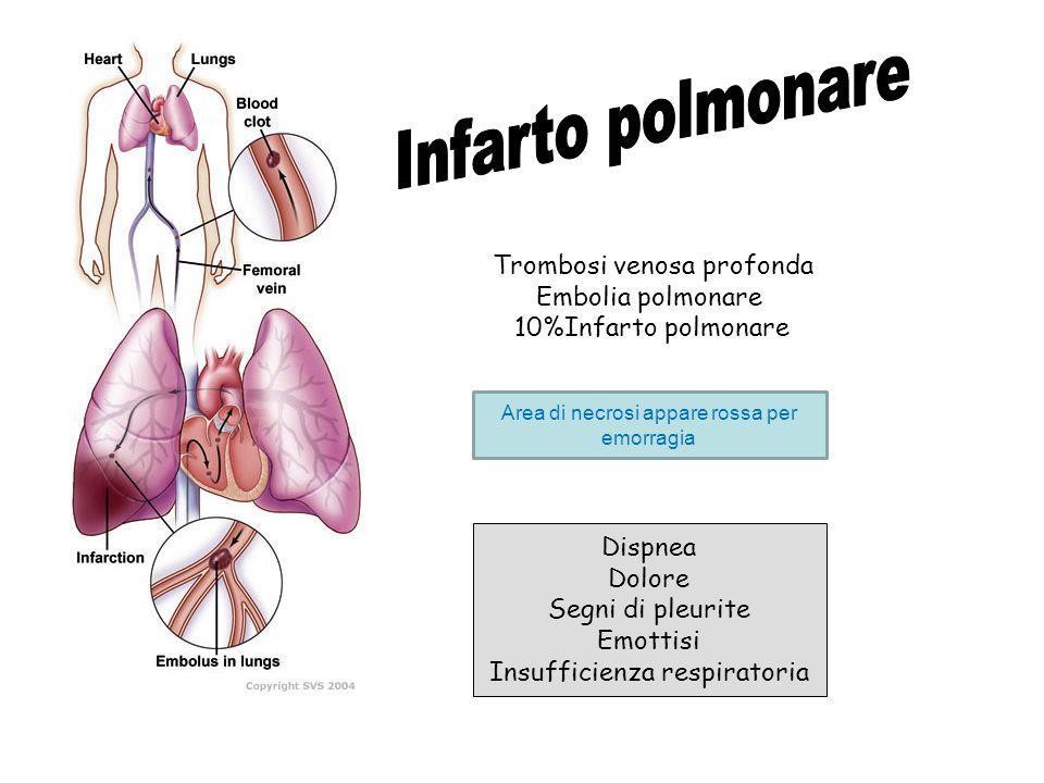 Embolia polmonare