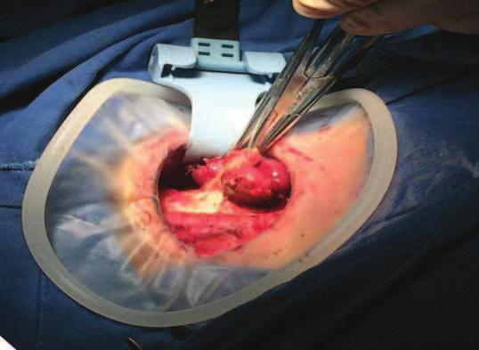 La forma circolare, rigida ed al tempo stesso elastica, consente di mantenere estesi e privi di deformazione i tessuti, offrendo al chirurgo una visione a 360 del campo operatorio.