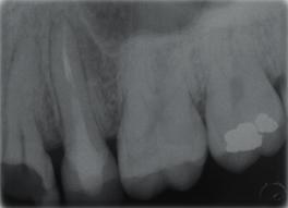 La cavità d accesso: strumentario e tecnica di esecuzione. Analisi degli errori e delle possibili soluzioni.