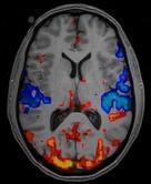 insorgere della patologia Microarra y di dati WGCNA Indici geneti ci f-mri Endofenotipi Approccio basato su