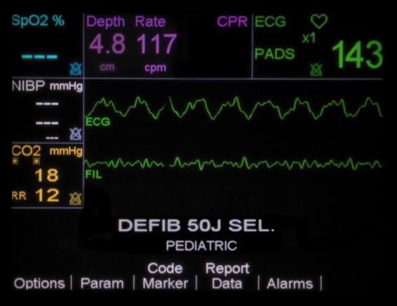 Soluzioni di ZOLL Il defibrillatore/monitor ZOLL R Series è il primo defibrillatore a offrire la possibilità di usare elettrodi pediatrici con un sensore RCP integrato.